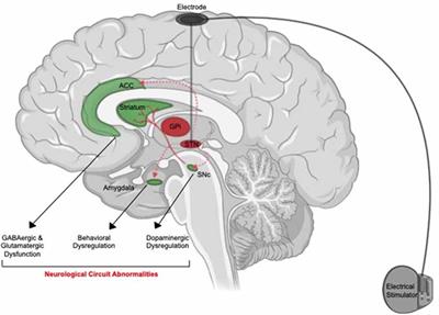 Suicidality Associated With Deep Brain Stimulation in Extrapyramidal Diseases: A Critical Review and Hypotheses on Neuroanatomical and Neuroimmune Mechanisms